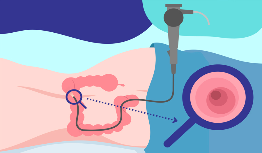 colonoscopy