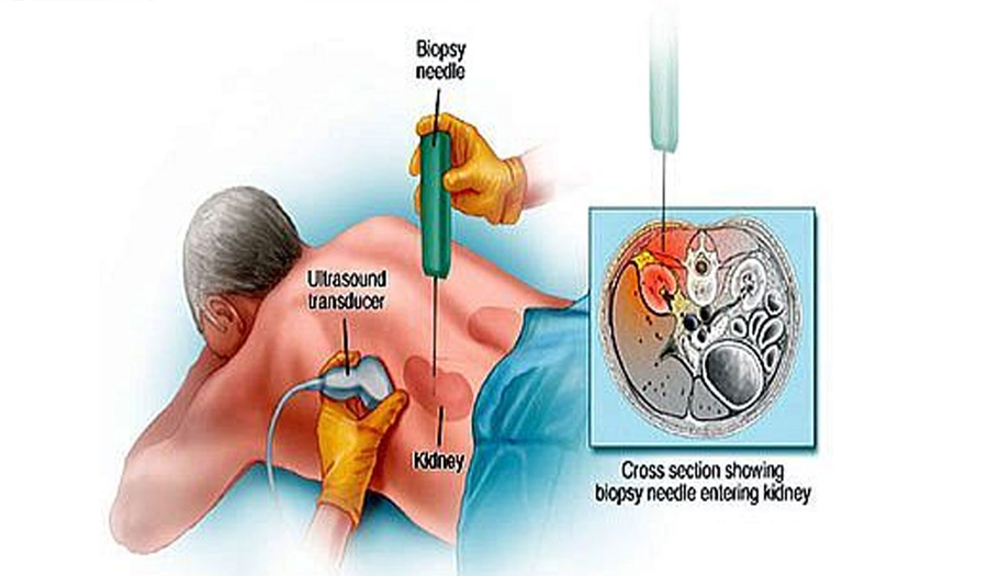 renal-biopsy